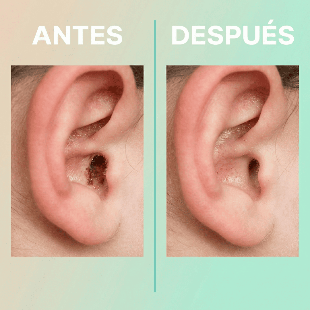 Limpieza de Oídos con Cámara HD