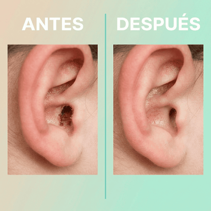 Limpieza de Oídos con Cámara HD